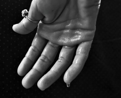 Comment réagir face à une hyperhidrose ?