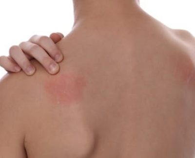 Attention aux médicaments qui peuvent augmenter votre sensibilité au soleil !